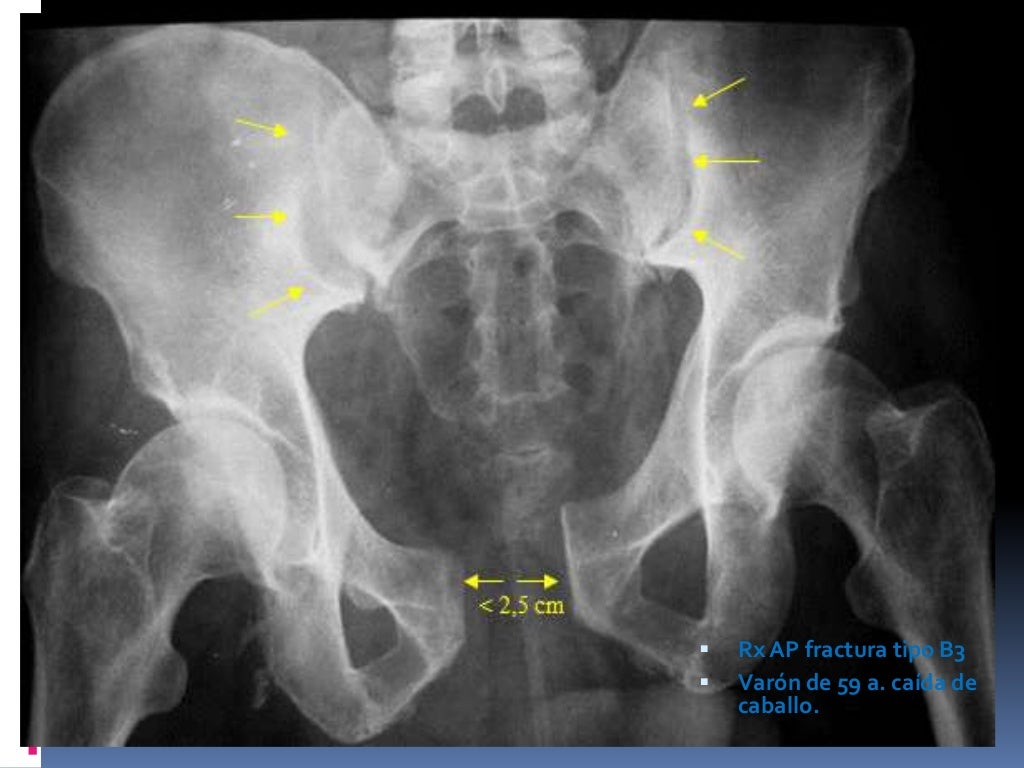 Fractura de pelvis trauma1total