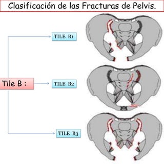 Generalidades de Fractura de pelvis y acetábulo . | PPTX