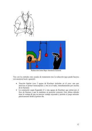 Reducción lenta Bajo Anestesia General


Tres son los métodos más usuales de tratamiento tras la reducción (que puede hacerse
con anestesia local o general):

   •   Tracción bipolar (con 2 agujas de Kischner incluidas en el yeso: una que
       atraviesa el primer metacarpiano y otra en el radio, inmediatamente por encima
       de la fractura)
   •   La contención según Kapandji (2 o más agujas de Kischner que entran por el
       foco de fractura y que la mantiene en posición correcta). Este último método
       tiene la ventaja de que no precisa vendaje enyesado y permite el juego articular
       prácticamente desde el primer día.




                                                                                    12
 