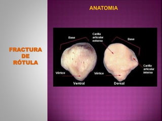 ANATOMIA
FRACTURA
DE
RÓTULA
 