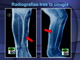 Radiografías tras la cirugía
 