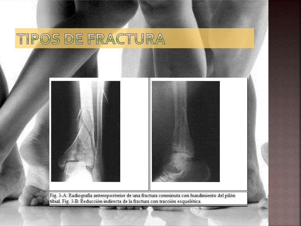 Tipos De Fracturas De Tobillo – Fractura de Tobillo: Clasificación ...