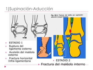 1)Supinación-Aducción




    ESTADIO 1
    Ruptura del
     ligamento externo
    Avulsión del maléolo
    externo
    Fractura horizontal
    Infra-ligamentaria                    ESTADIO 2
                               Fractura del maléolo interno
 