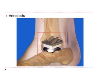    Artrodesis
 