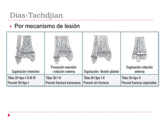 Dias-Tachdjian
   Por mecanismo de lesión
 