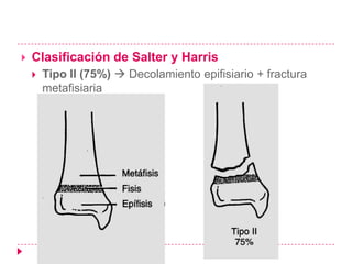    Clasificación de Salter y Harris
       Tipo II (75%)  Decolamiento epifisiario + fractura
        metafisiaria
 