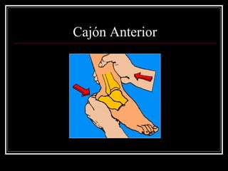 Cajón Anterior
 
