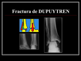 Fractura de DUPUYTREN
 