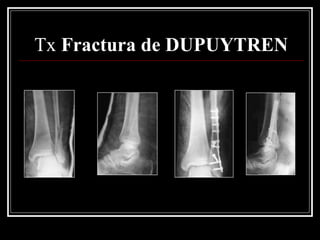 Tx Fractura de DUPUYTREN
 
