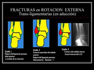 FRACTURAS en ROTACION EXTERNA
          Trans-ligamentarias (en aducción)




                                 Estadio 2                         Estadio 3
Estadio 1                        Fractura espiroidea del maléolo      Fractura del maléolo interno
Ruptura del ligamento peroneo-   externo                               (trazo transversal) o LLI
tibial anterior                  Ruptura del ligamento peroneo-
 o avulsión de su inserción      tibial posterior Diastasis ++
 