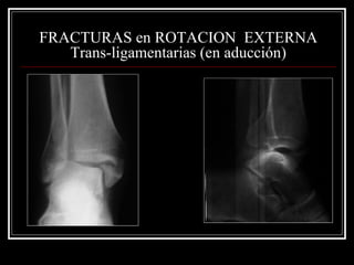 FRACTURAS en ROTACION EXTERNA
   Trans-ligamentarias (en aducción)
 