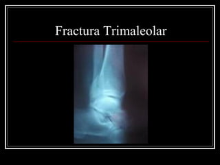 Fractura Trimaleolar
 