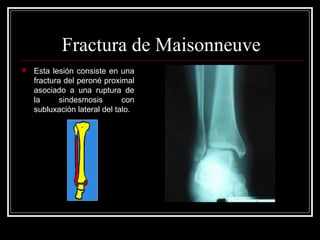 Fractura de Maisonneuve
   Esta lesión consiste en una
    fractura del peroné proximal
    asociado a una ruptura de
    la      sindesmosis       con
    subluxación lateral del talo.
 