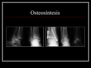 Osteosíntesis
 