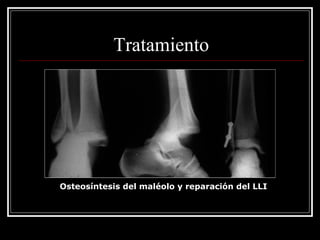 Tratamiento




Osteosíntesis del maléolo y reparación del LLI
 