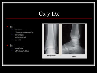 Cx y Dx
   Cx:
         Dolor Intenso.
         El Paciente no puede apoyar el pie.
         Cojera antálgica.
         Tumefacción variable.
         Deformidad.


   Dx:
         Historia Clínica.
         Rx AP, Lateral y/o Oblicua
 