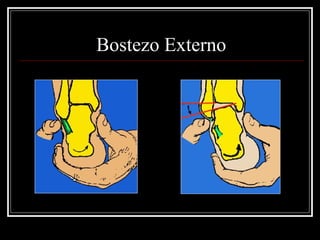 Bostezo Externo
 