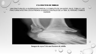 Fractura de tobillo | PPT
