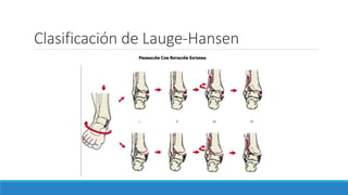Clasificación de Lauge-Hansen
 