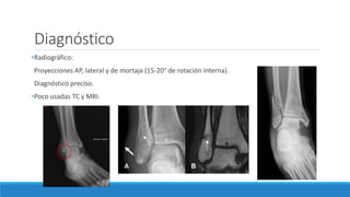 Diagnóstico
•Radiográfico:
Proyecciones AP, lateral y de mortaja (15-20° de rotación interna).
Diagnóstico preciso.
•Poco usadas TC y MRI.
 