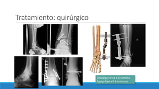 Tratamiento: quirúrgico
Descarga hasta 4-6 semana.
Apoyo hasta 6-8 semanas.
 