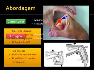  Fracturas Estáveis:
- <50% descoaptação
- <40º de angulação
- Obliquidade<60º
Conservador
 Maioria das Fracturas do colo e diáfise
 Fracturas estáveis e coaptadas da cabeça e base
Cirúrgico
 Deformidade rotacional
 Encurtamento
 Tala gessada
 Flexão da MCF em 90º
 Dorsiflexão do punho
  3 semanas
 