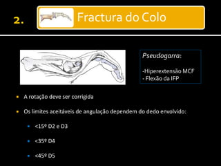 Fractura do Colo
Pseudogarra:
-Hiperextensão MCF
- Flexão da IFP
 A rotação deve ser corrigida
 Os limites aceitáveis de angulação dependem do dedo envolvido:
 <15º D2 e D3
 <35º D4
 <45º D5
 