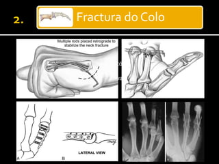Fractura do Colo
 Cirurgia:
 Redução e/ou angulação insatisfatórias
 Rotação
 Cominução volar (indicação relativa)
 