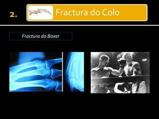 Fractura do Colo
Fractura do Boxer
 