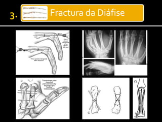 Fractura da Diáfise
 