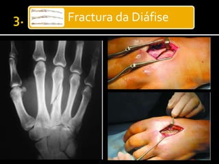 Fractura da Diáfise
 