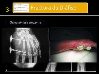 Fractura da Diáfise
Osteossíntese em ponte
 