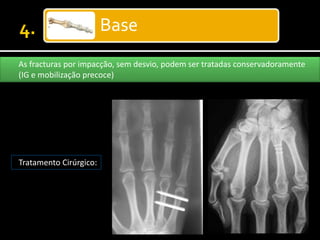 Base
As fracturas por impacção, sem desvio, podem ser tratadas conservadoramente
(IG e mobilização precoce)
Tratamento Cirúrgico:
 
