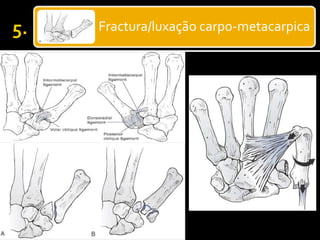 Fractura/luxação carpo-metacarpica
 