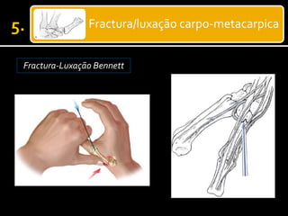 Fractura/luxação carpo-metacarpica
Fractura-Luxação Bennett
 
