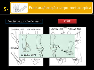 Fractura/luxação carpo-metacarpica
Fractura-Luxação Bennett CRIFORIF
 