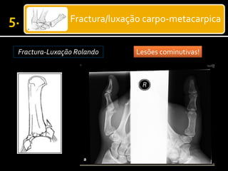 Fractura/luxação carpo-metacarpica
Fractura-Luxação Rolando Lesões cominutivas!
 