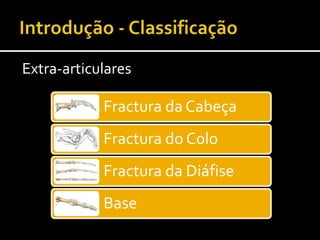 Fractura da Cabeça
Fractura do Colo
Fractura da Diáfise
Base
Extra-articulares
 