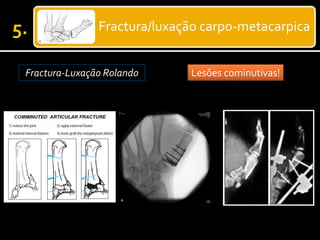 Fractura/luxação carpo-metacarpica
Fractura-Luxação Rolando Lesões cominutivas!
 