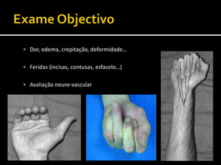  Dor, edema, crepitação, deformidade…
 Feridas (incisas, contusas, esfacelo…)
 Avaliação neuro-vascular
 