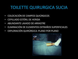 COLOCACIÓN DE CAMPOS QUIÚRGICOSCEPILLADO ESTÉRIL DE HERIDAABUNDANTE LAVADO DE ARRASTREELIMINACIÓN DE ELEMENTOS EXTRAÑOS SUPERFICIALESEXPLORACIÓN QUIRÚRGICA: PLANO POR PLANOTOILETTE QUIRURGICA SUCIA