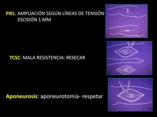 PIEL: AMPLIACIÓN SEGÚN LÍNEAS DE TENSIÓN          ESCISIÓN 1 MMTCSC: MALA RESISTENCIA: RESECARAponeurosis: aponeurotomía- respetar