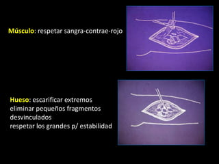Músculo: respetar sangra-contrae-rojoHueso: escarificar extremos    eliminar pequeños fragmentos desvinculadosrespetar los grandes p/ estabilidad