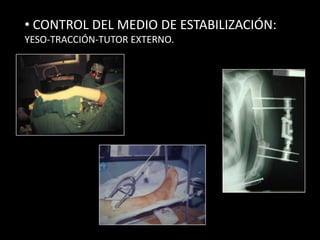  SEGUNDA INTENCIÓN