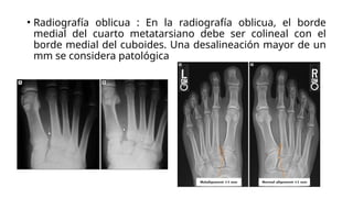 fractura-luxacion-de-lisfranck-en-adultos-pptx