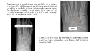 fractura-luxacion-de-lisfranck-en-adultos-pptx