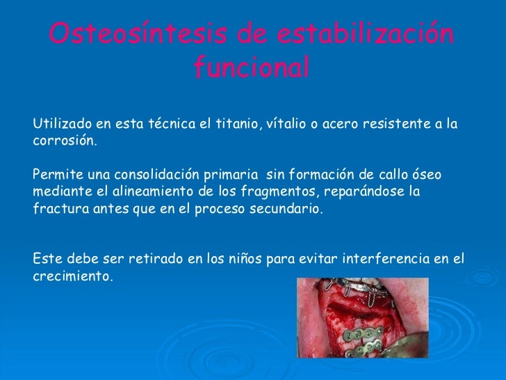 material nylon es que MANDIBULAR FRACTURA material nylon es que MANDIBULAR FRACTURA