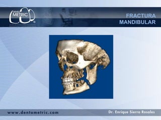 Fractura mandibular | PPTX