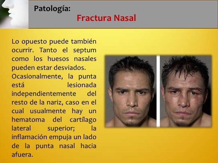 Fractura nasal