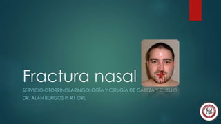 Fractura nasal
SERVICIO OTORRINOLARINGOLOGÍA Y CIRUGÍA DE CABEZA Y CUELLO

DR. ALAN BURGOS P. R1 ORL

 